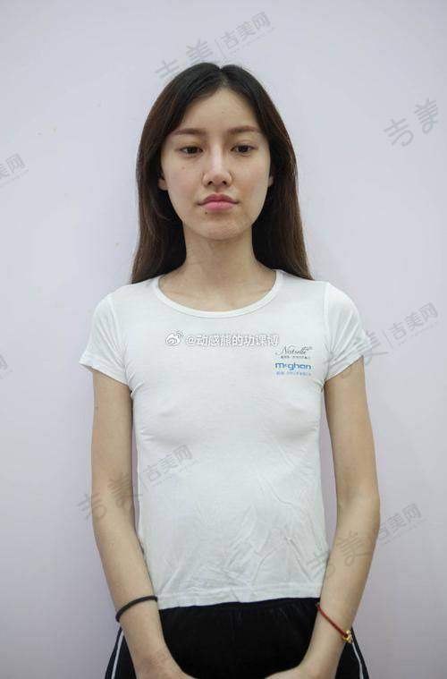 揭阳维多利亚整形玻尿酸注射丰胸23750元起优势全方面展示