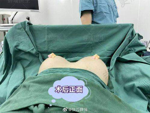 曼托和傲诺拉假体隆胸长期成效稳定性对比