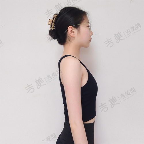 曼托和傲诺拉假体隆胸形态设计对比