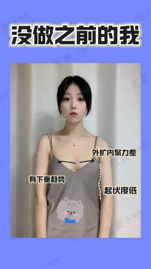 曼托和傲诺拉假体隆胸术后护理要点对比