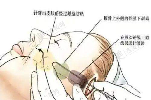 广州雅妍时光孙恺操刀自体耳软骨隆鼻15780起优势在哪?