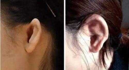 广州雅妍时光孙恺操刀自体耳软骨隆鼻15780起手术过程怎样?