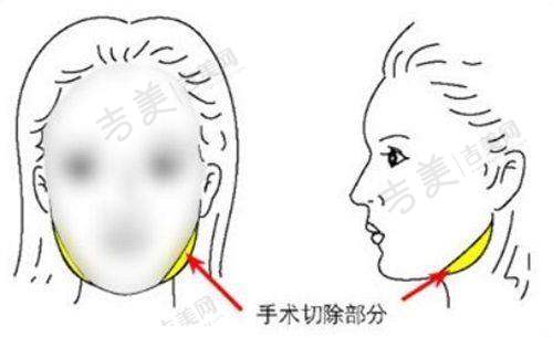 杭州格莱美隆胸：陈郇医生的术后跟踪与指导
