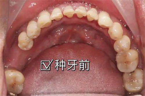 瑞士士卓曼iti种植牙存在哪些不足之处