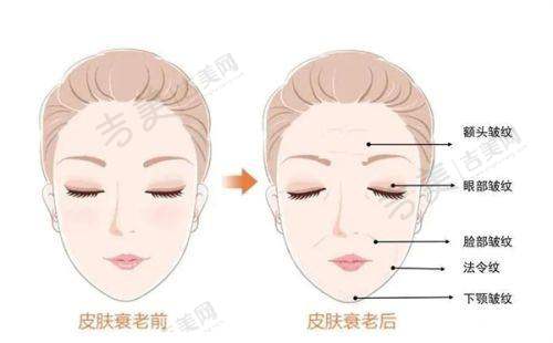 济南做激光祛斑好的医院之美莱的治疗成效如何？
