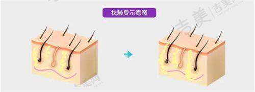 广州雅妍时光孙恺操刀自体耳软骨隆鼻15780起有风险吗?