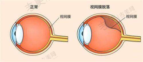刘苏冰做近视手术怎么样：价格合理性分析