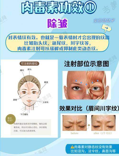 德国西马肉毒素100u价格与个人体质的关系