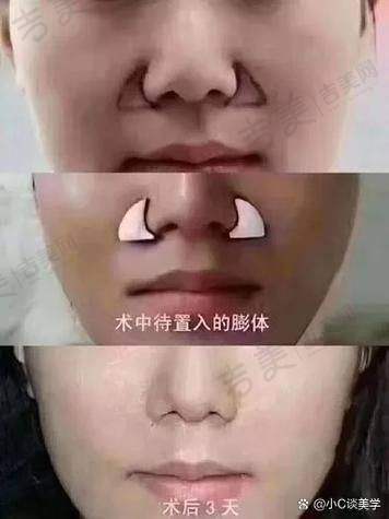 其他情况对假体隆鼻维持一辈子的影响