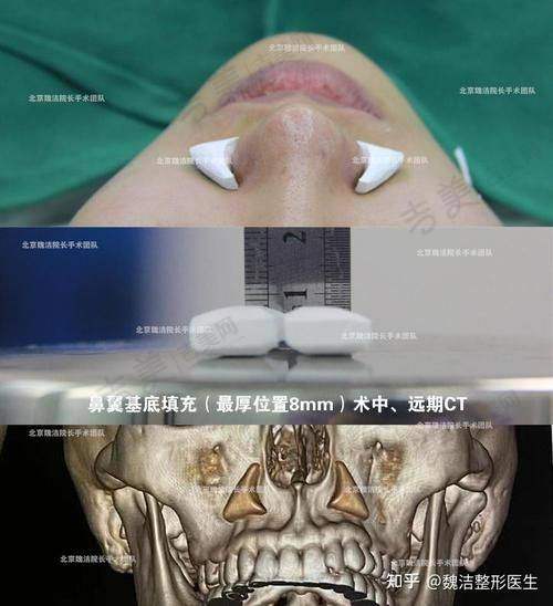 硅胶假体隆鼻能否维持一辈子