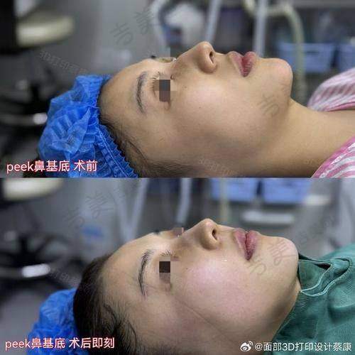 假体隆鼻维持一辈子的概率分析