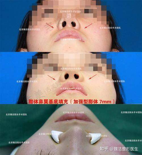 如何让假体隆鼻尽可能维持一辈子