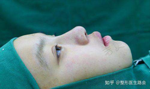 舒铂超肋假体隆鼻能否维持一辈子