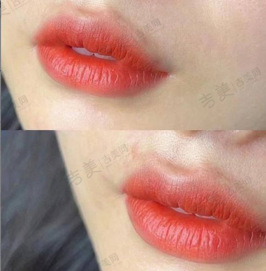 杭州格莱美隆胸：价格合理性分析