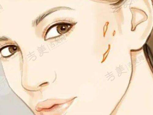 二、上海张园园做双眼皮修复有什么优势？