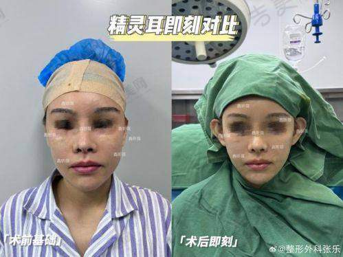 中山大学附属第一医院整形科唇裂修复收费价格有优惠活动吗？