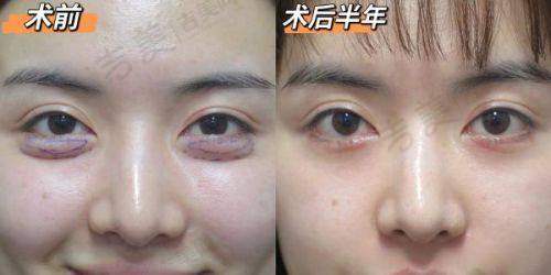 广州韩妃李光琴双眼皮修复手术精细度咋样？