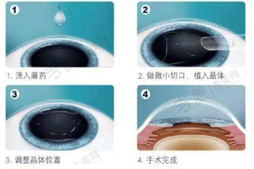 攀枝花五医院眼科飞秒近视手术术前检查费用是多少？