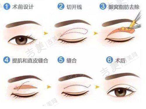 广州韩妃李光琴常规双眼皮手术技术亮点在哪？