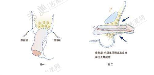 广州华美整形医院好不好正规吗真实项目实例公布:抗衰实例分享