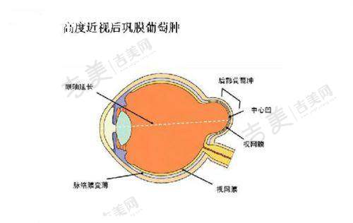 南京华厦眼科医院全飞秒激光手术价格情况如何？