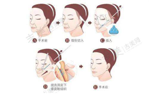 西安美合医疗美容（未央店）张柱允医生的专长项目有哪些？