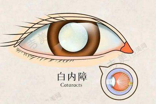 四平爱尔眼科医院近视手术优势凸显