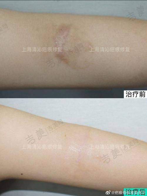 青海省人民医院整形科项目特色