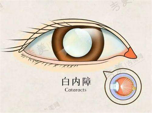 贵阳爱尔眼科医院近视手术价目表