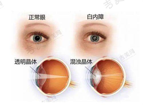 广州花都爱尔眼科医院特色诊疗项目