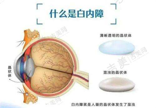 大同爱尔眼科医院常见问题解答