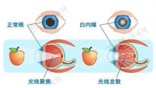 毕节爱尔眼科医院实力与优势解析