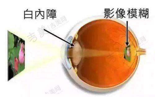 广州爱尔眼科医院近视手术医生与价格详情