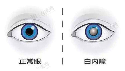 天水爱尔眼科医院实力与项目价格