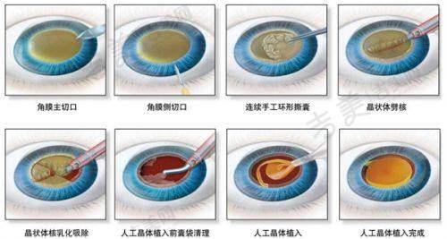 广州花都爱尔眼科医院价格体系情况