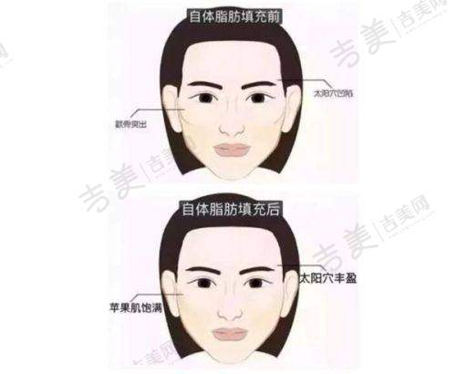 苏州打瘦脸针哪家医院好？私立医美机构之苏州薇琳美容医院