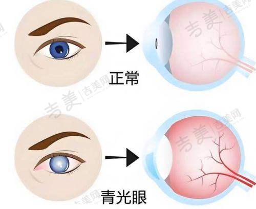 甘肃爱尔眼科医院近视手术优势显著