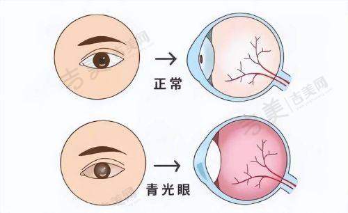 广州黄埔爱尔眼科医院患者口碑反馈