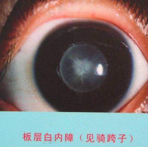 广州花都爱尔眼科医院对当地眼科医疗的贡献