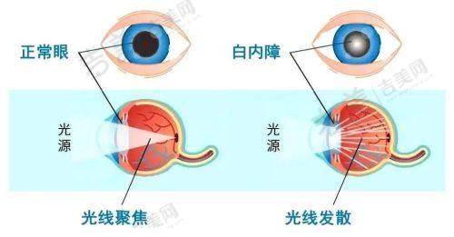 福州爱尔眼科医院的近视手术服务