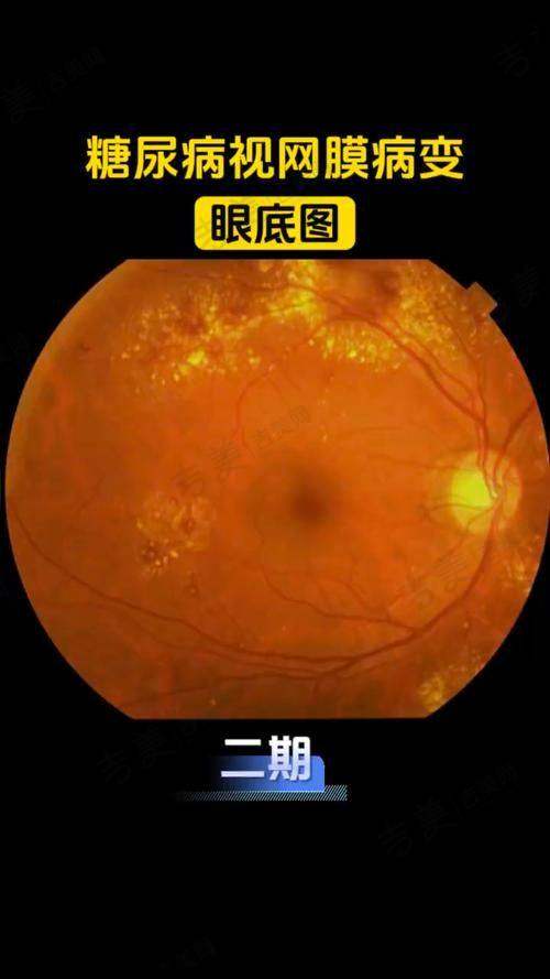广州爱尔眼科医院小儿眼病手术医生名单有谁？谢亚林等医生技术优，案例效果好值得约