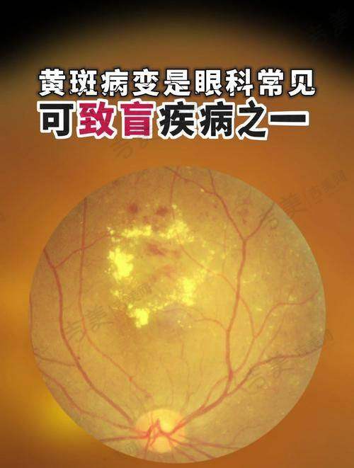福州爱尔眼科医院的特色项目 - 斜弱视治疗