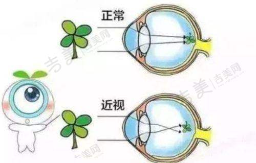 广西医 科 大学附属第一医院眼科白内障手术价格与特点