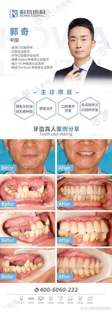 三、杨彦春医生种植牙手术体验，真实感受大分享