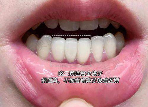三、杨捷医生手术体验如何