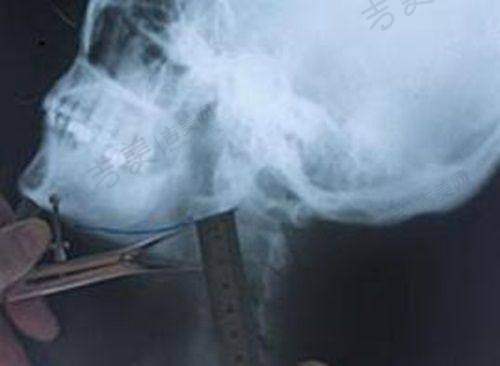 二、淄博壹美整形美容医院正规吗？提眉手术见真章