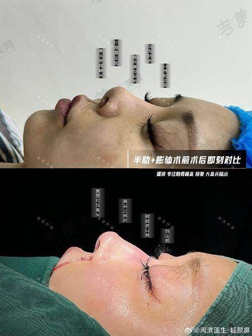 林华芬医生手术费用