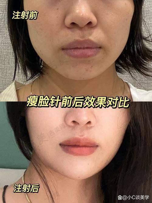 三、牛文贺医生手术体验分享