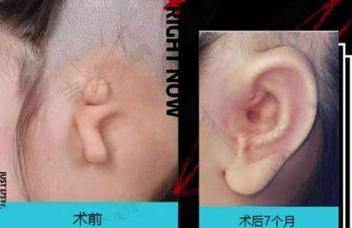 长沙美莱和亚韩哪家好？热玛吉项目对比分析