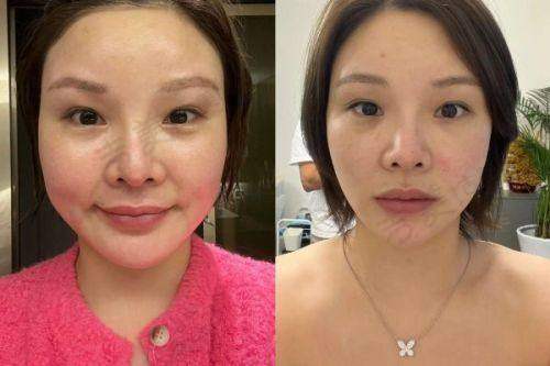 丽水心艺医疗美容的隆胸秘籍